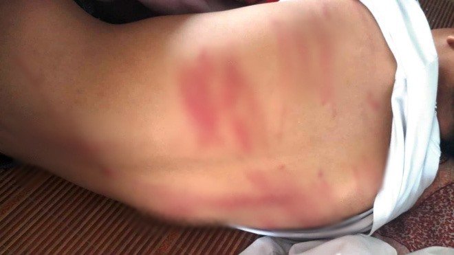 Nam sinh lớp 8 ngất xỉu tại lớp sau trận đòn roi của bố đẻ
