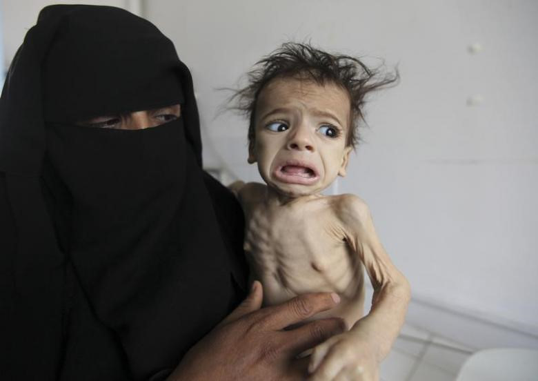 Trẻ Yemen còn da bọc xương vì nạn đói thảm khốc